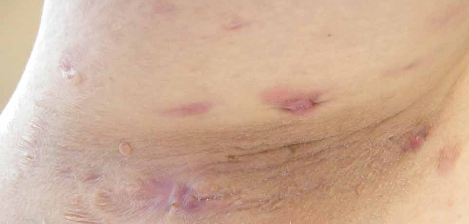 hs derma