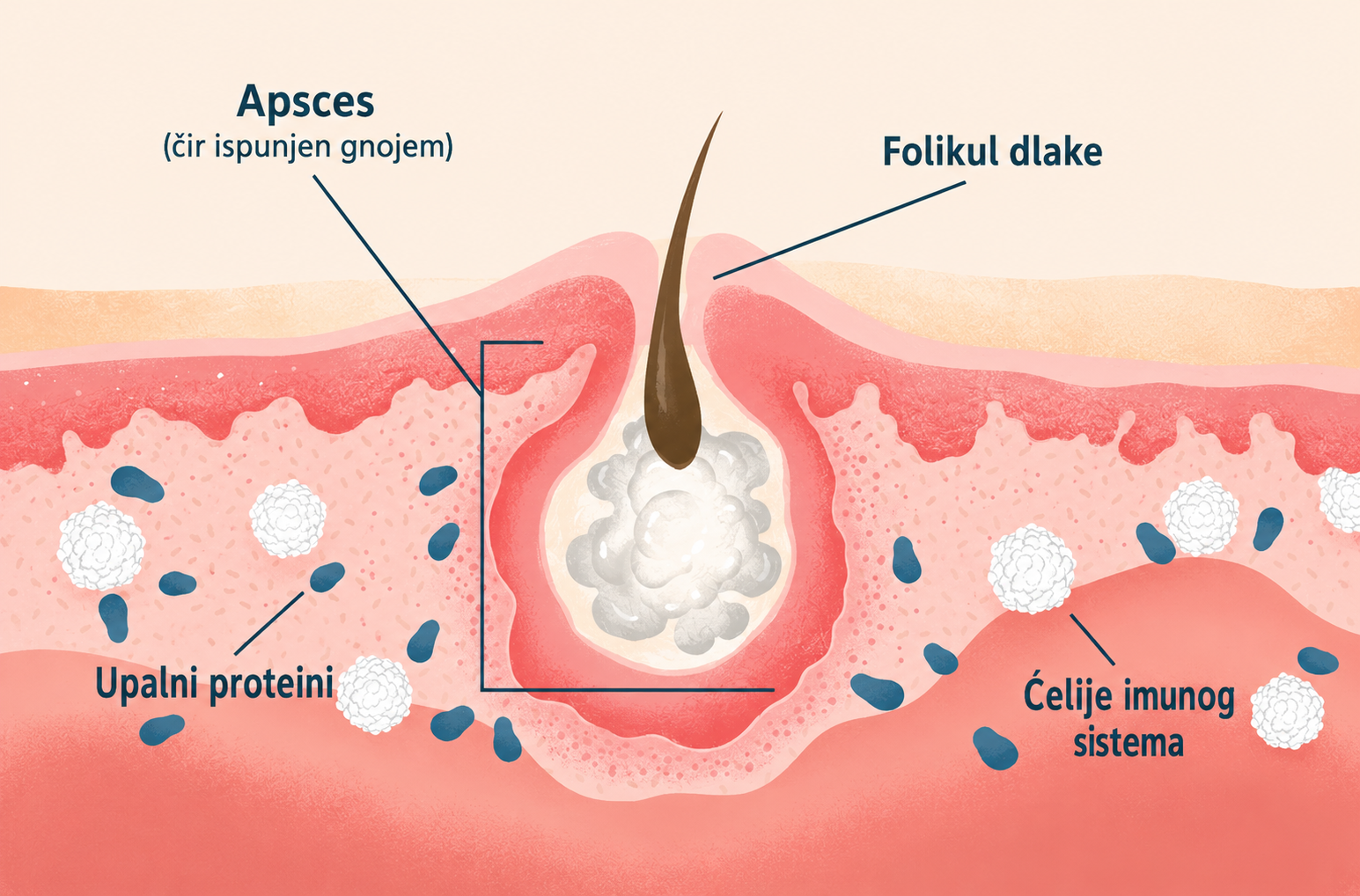 hs uzroci 2